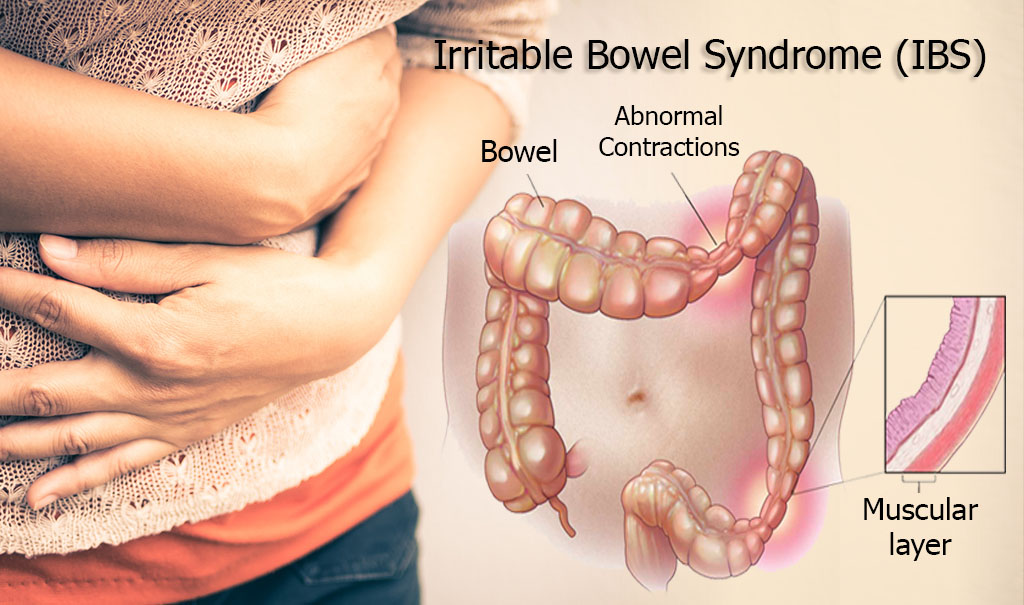 Chia colon irritable