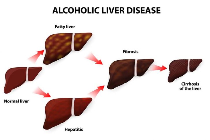 Ascites (Excess Abdominal Fluid); Causes, Symptoms and Treatment