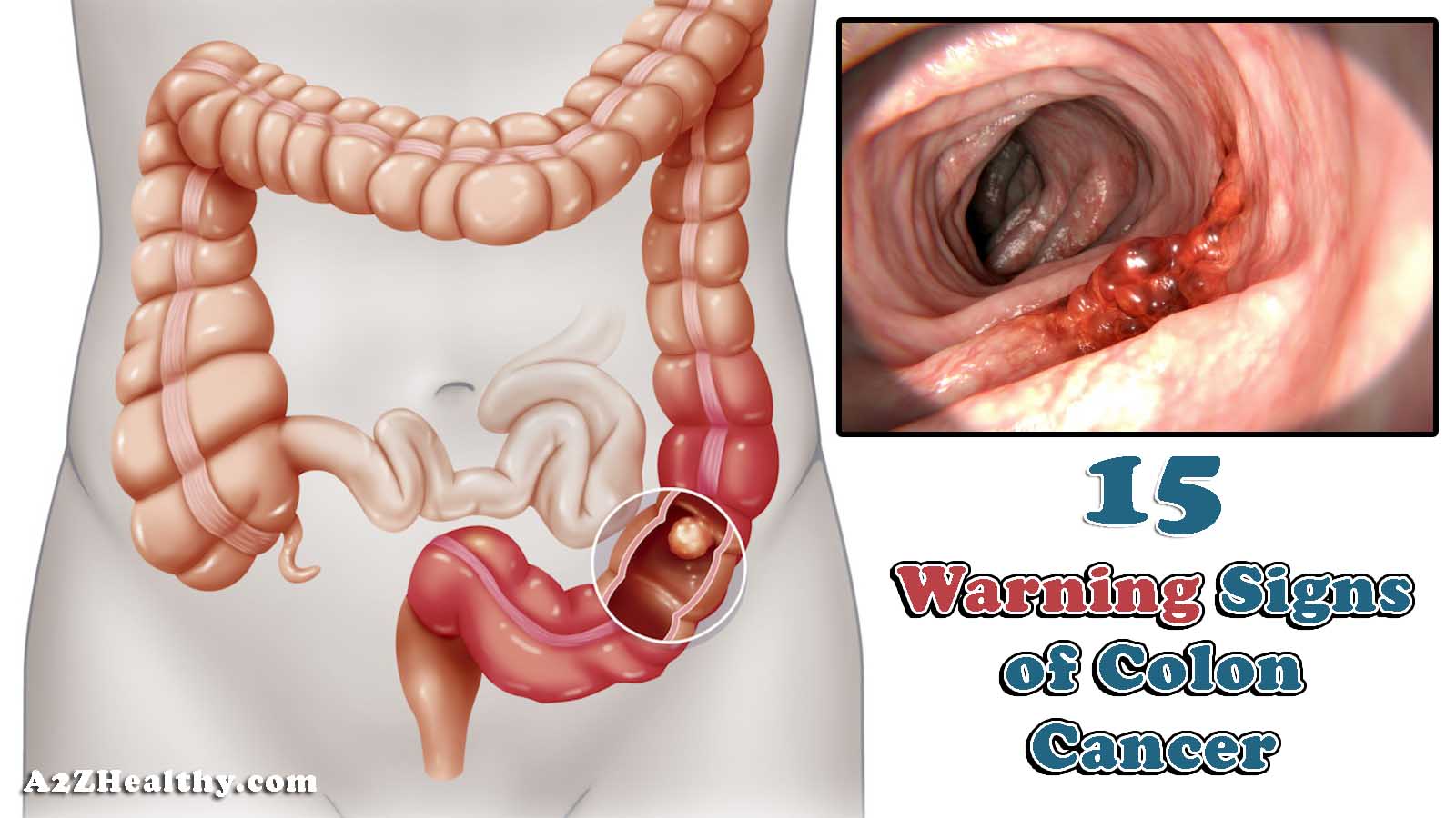 15 Warning Signs Of Colon Cancer You Should Not Ignore