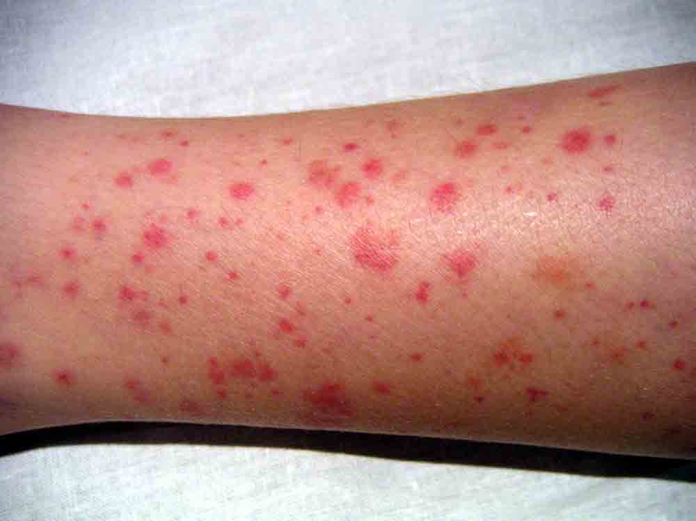 Ecchymosis; Definition, Symptoms, Causes and Treatments