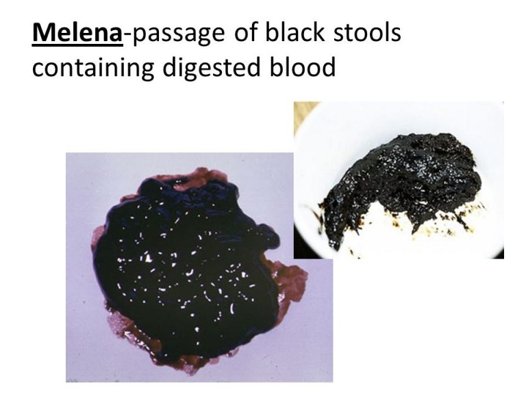 Blood In Stool Melena Of All Time The Ultimate Guide Stoolz   Melena 768x576 