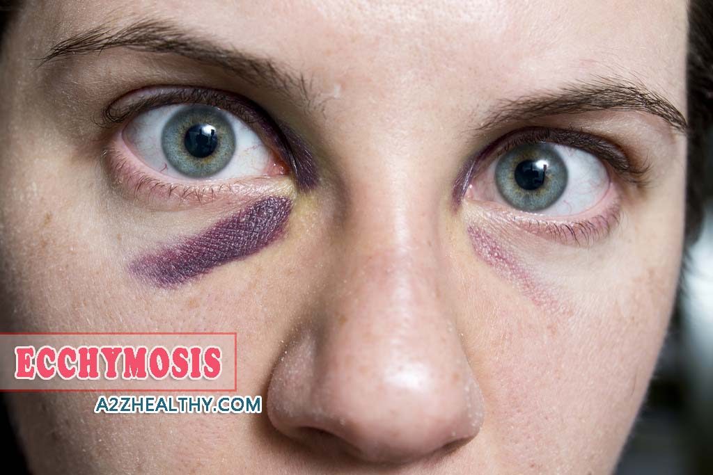 Ecchymosis