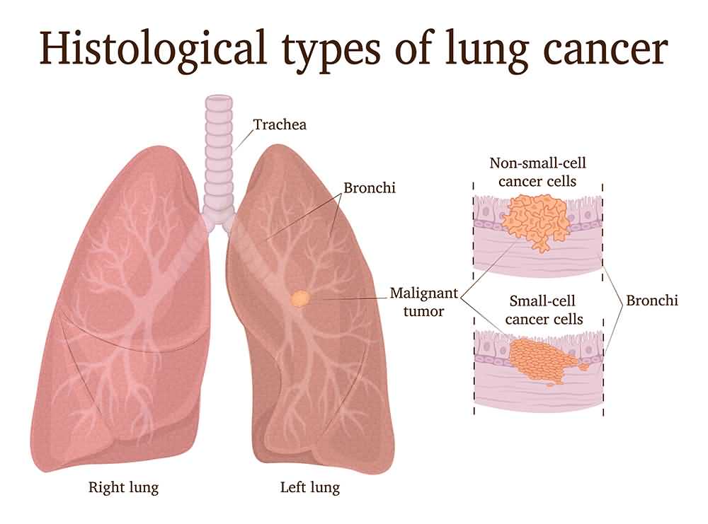 Types Of Lung Cancer