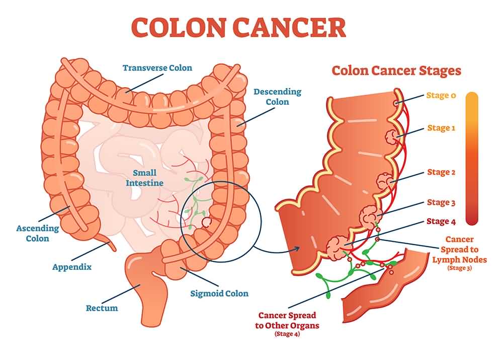 What Are The Three Types Of Colon Cancer