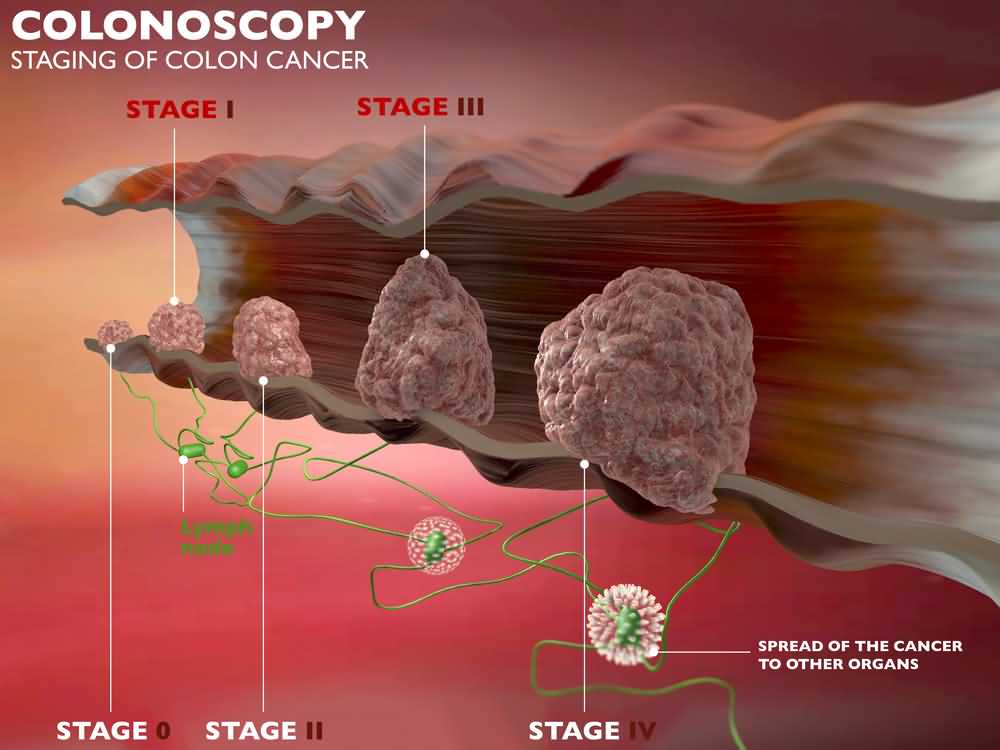 Colon Cancer; Stages, Symptoms, Causes and Screening