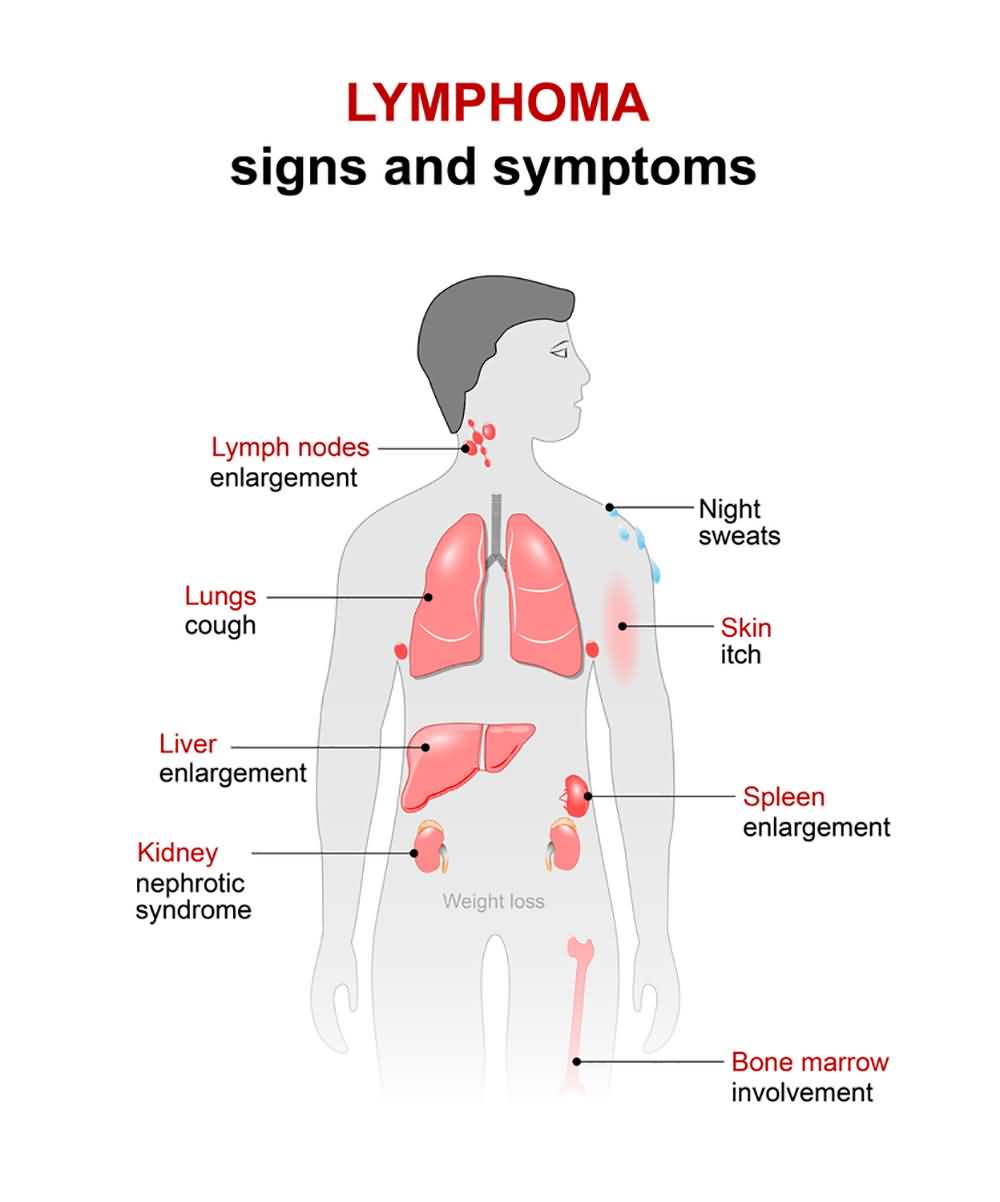 Lymphoma Symptoms 9 Signs Of Hodgkins And Non Hodgkins Lymphoma 