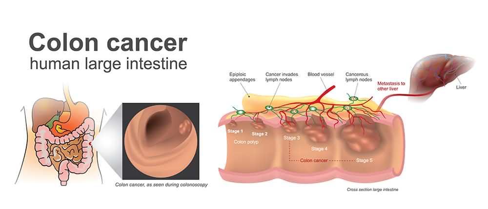 Colon Cancer Stages Symptoms Causes And Screening