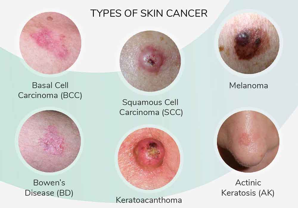 What Do Cancer Bumps Look Like On Skin