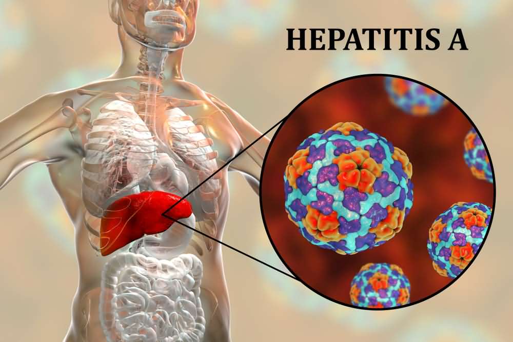 Hepatitis A; Transmission, Symptoms, Diagnosis & Treatment