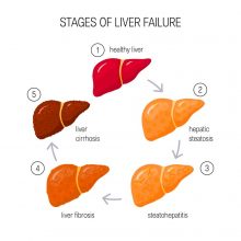 Alcoholic Fatty Liver Disease > How to Reverse Alcoholic Fatty Liver?