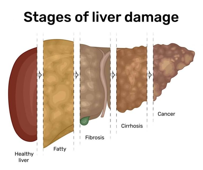 13 Signs of Liver Damage; How to Know if You Have Liver Damage?