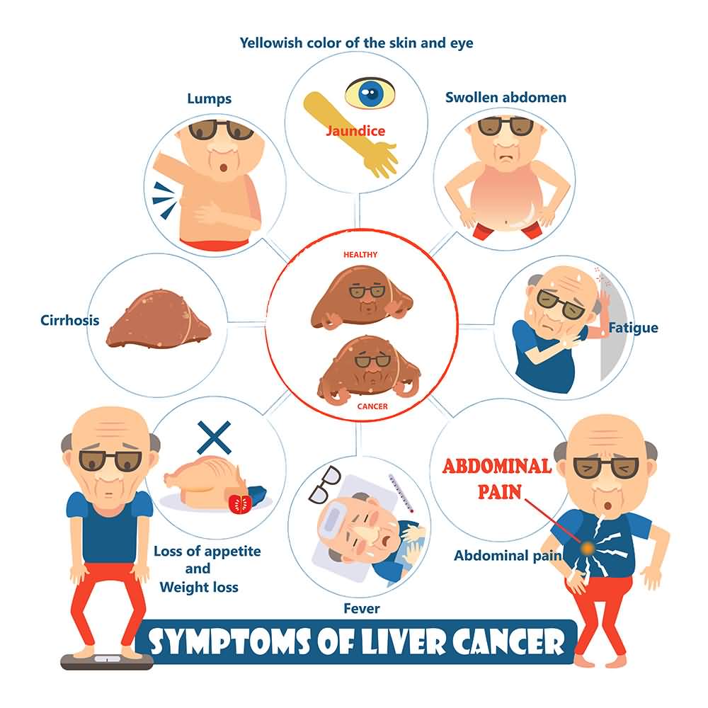 15 Signs and Symptoms of Liver Cancer You Should Not Ignore