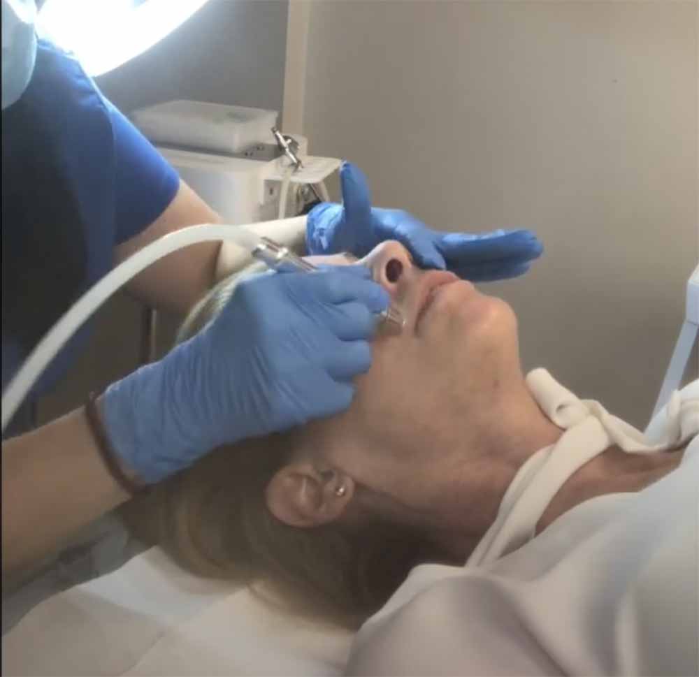 Dermabrasion