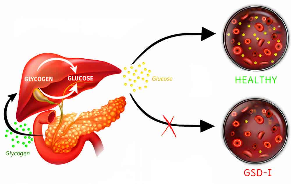 glycogen-storage-disease-type-i-gsd-i-von-gierke-disease