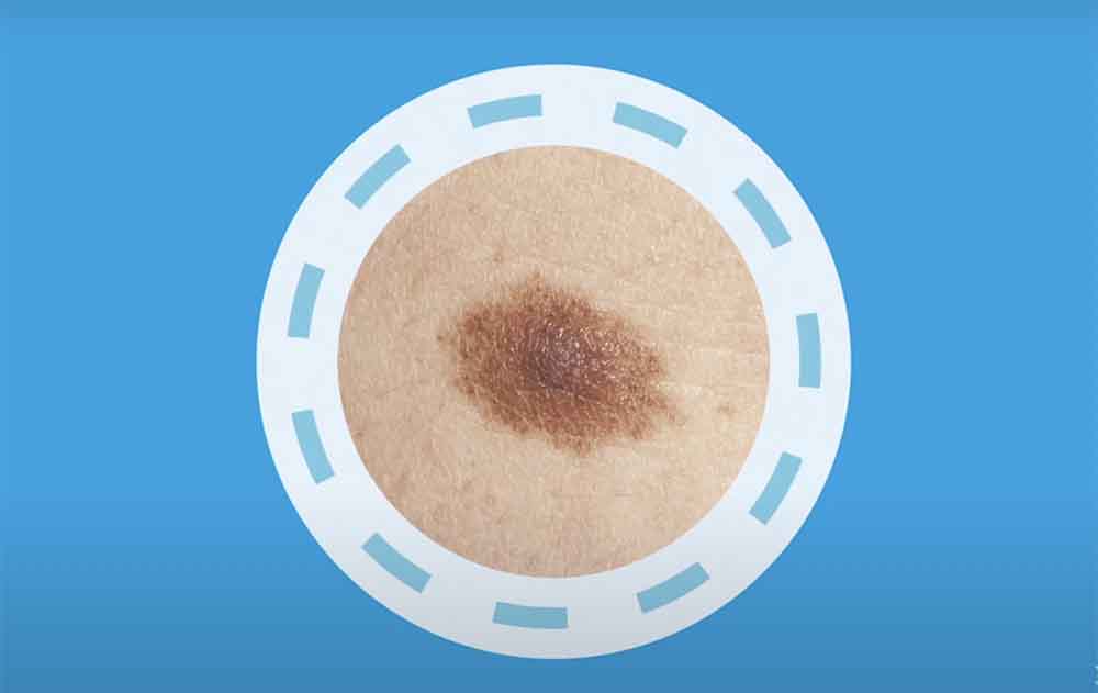 Large skin spot