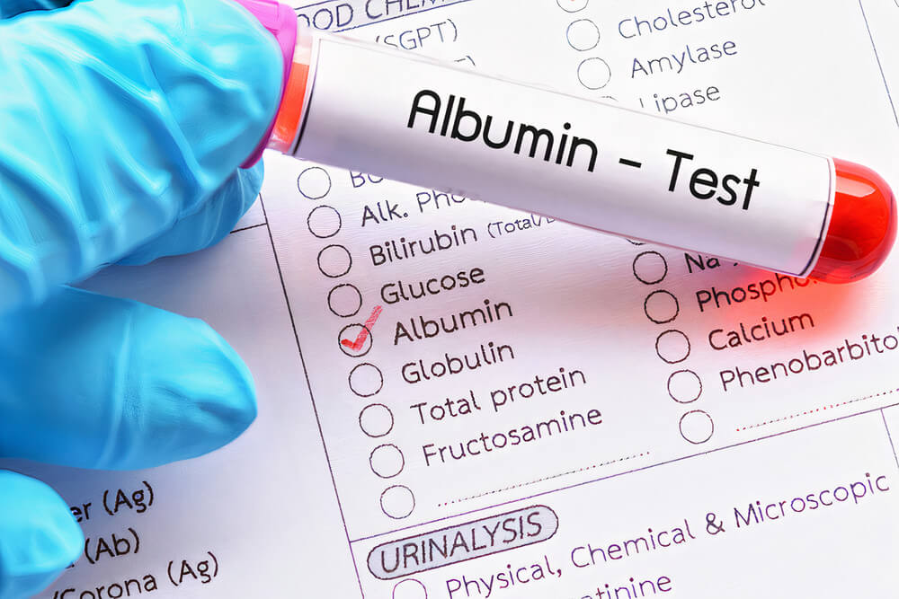 What Does It Mean to Have High or Low Albumin Levels? - Page 3 of 6