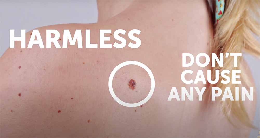 Skin Tags