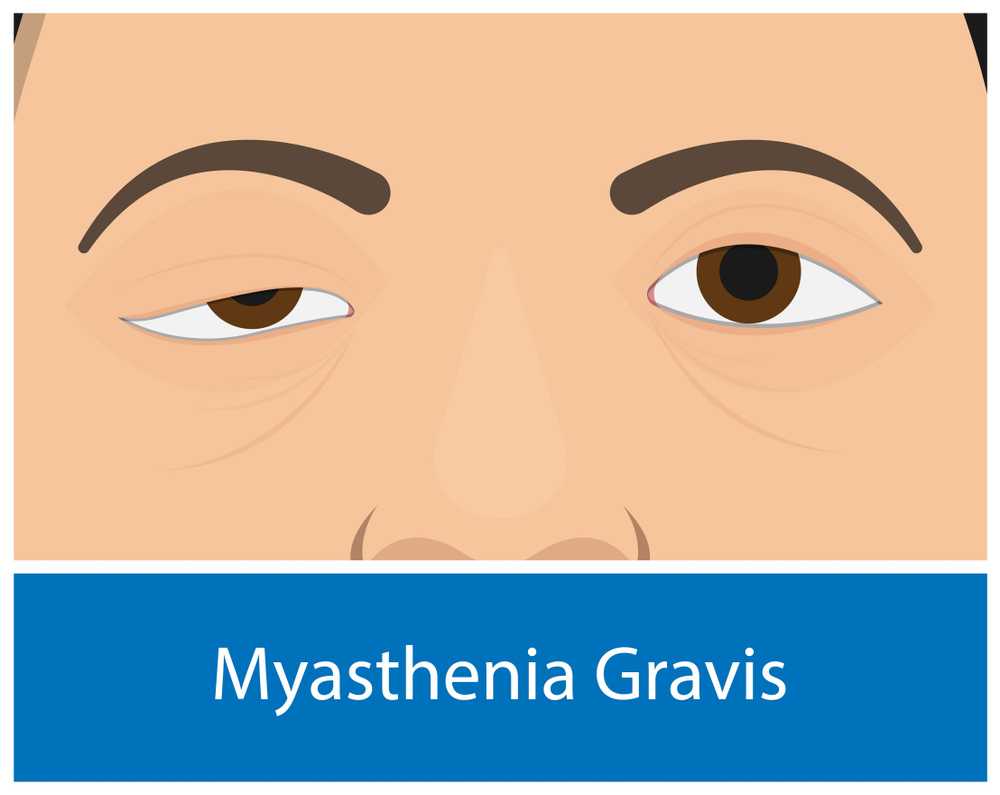 Myasthenia Gravis; Symptoms, Causes & Treatment - Page 2 Of 10 - A2Z ...