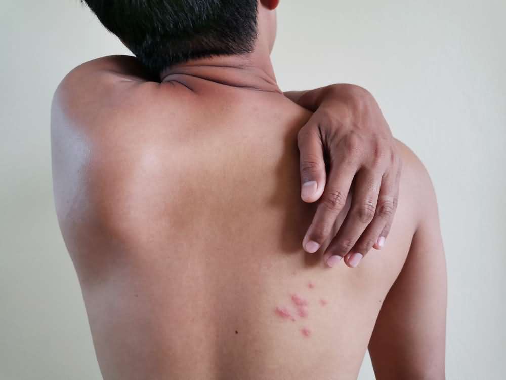 Heat Rash
