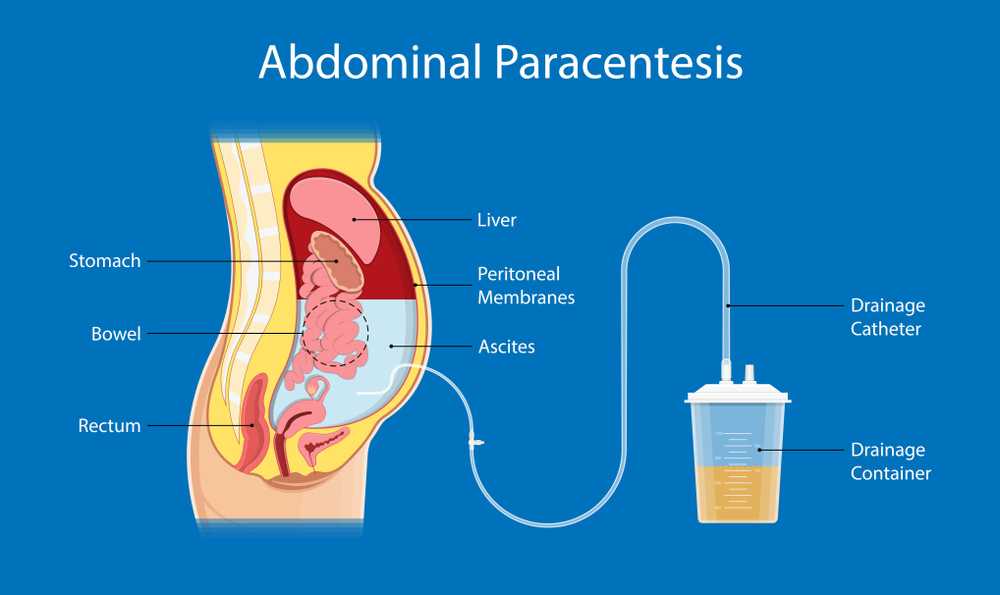 Paracentesis; Risks & Complications of Paracentesis - Page 3 of 9