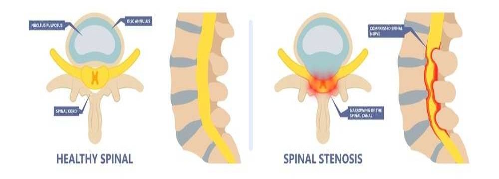 Spinal Stenosis; Causes, Symptoms, Treatment & Prevention - A2Z Healthy