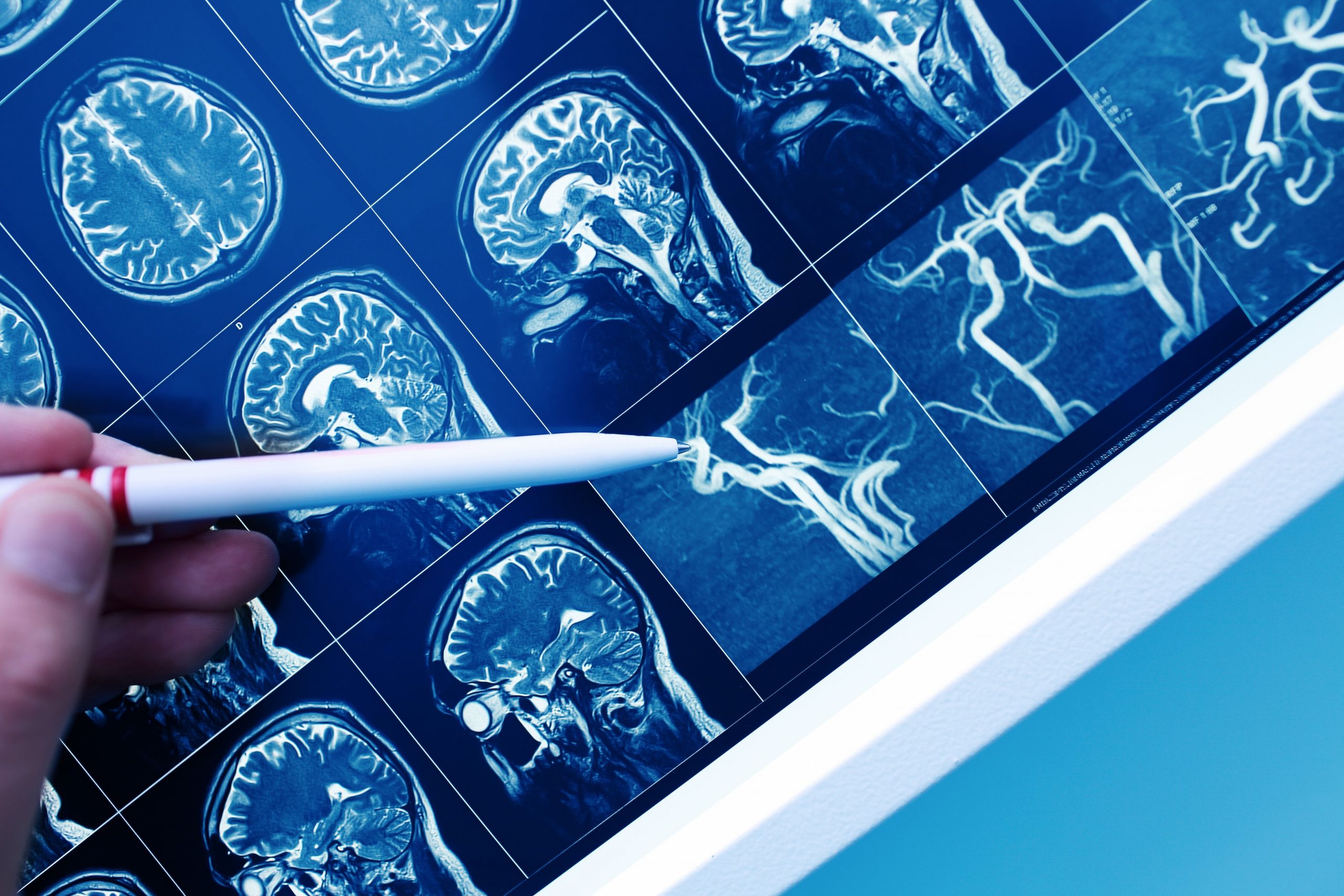 Vascular dementia stages