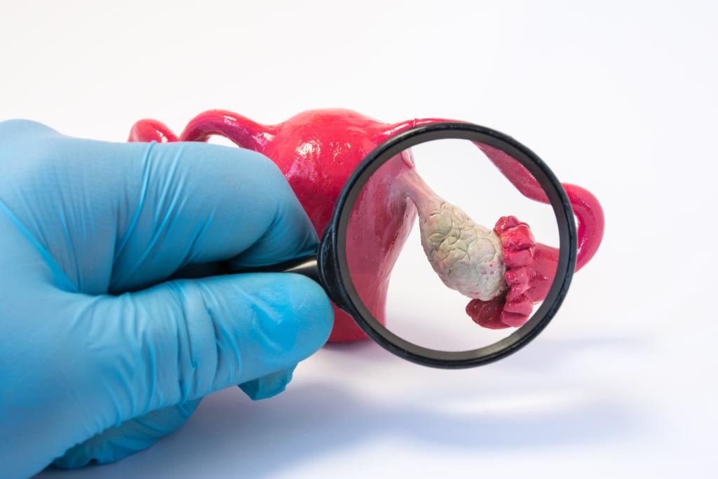 Ovarian Cancer Symptoms