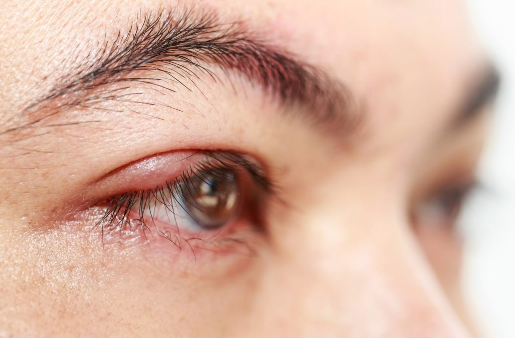 Blepharitis Symptoms