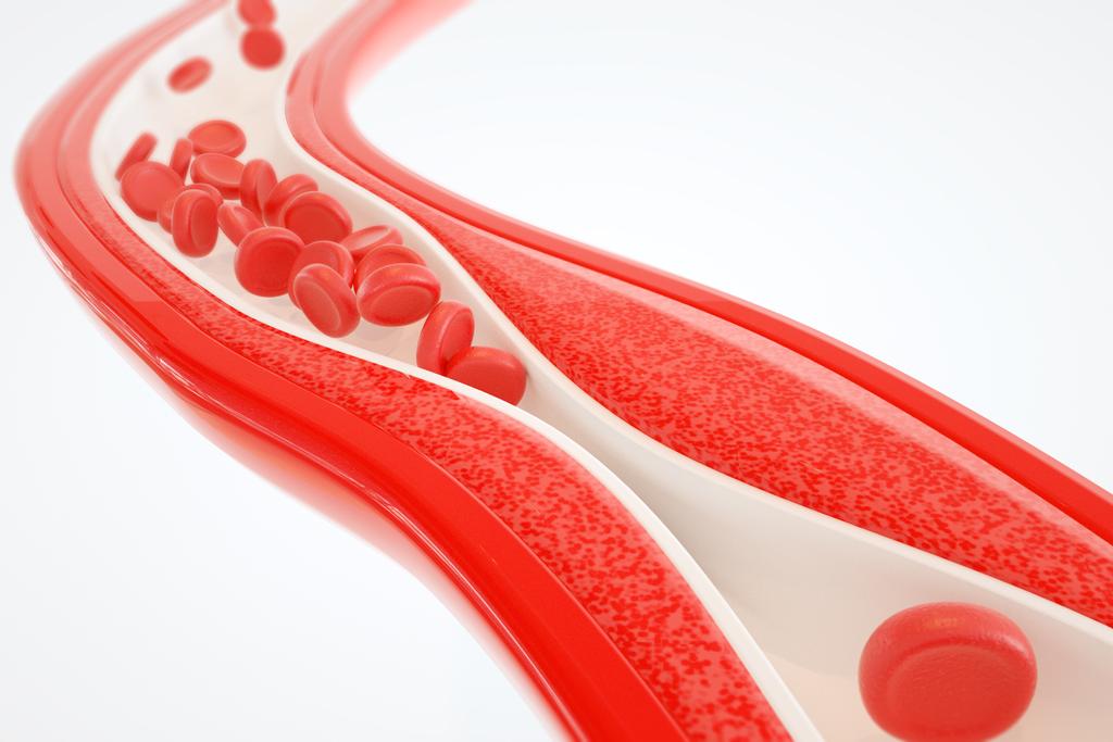 Atherosclerosis