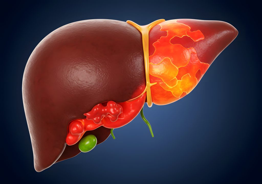 Early Warning Signs of Liver Damage